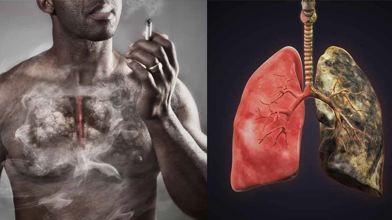Hút thuốc lá là nguyên nhân hàng đầu gây ung thư phổi 