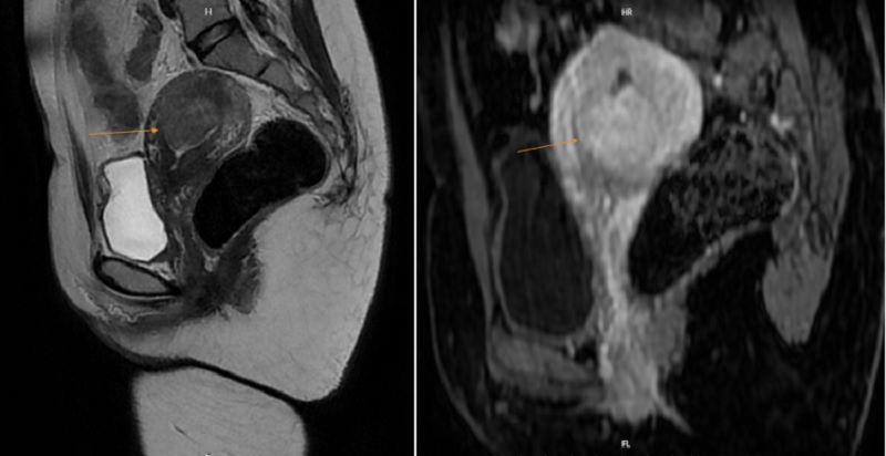 MRI phát hiện một khối u ở trong buồng tử cung của bệnh nhân