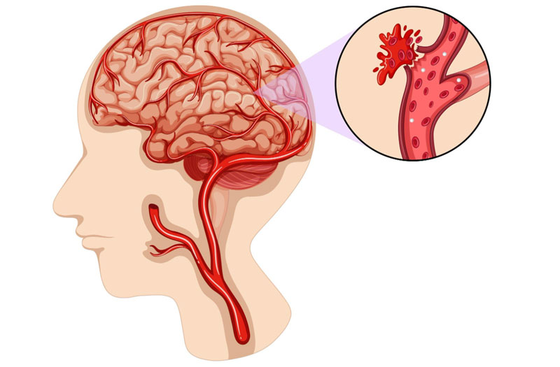 Dị dạng mạch máu não làm tăng nguy cơ vỡ mạch máu não