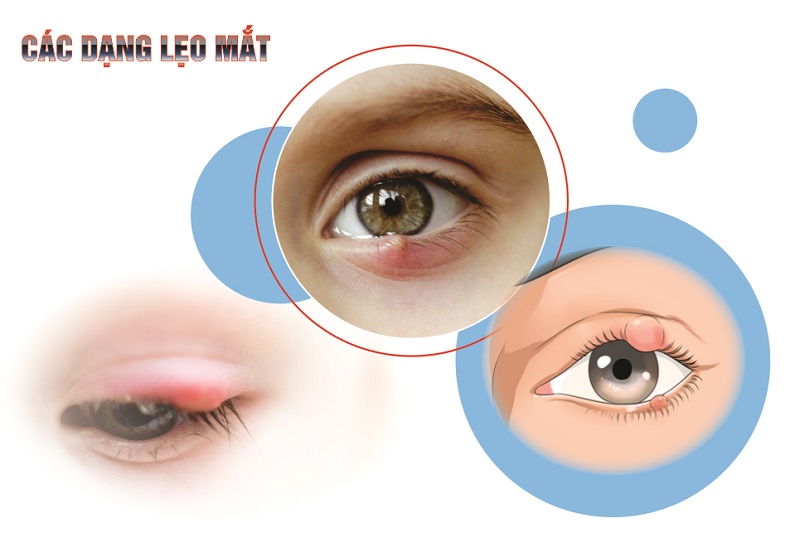Lẹo mắt có hai loại chính là lẹo ngoài và lẹo trong