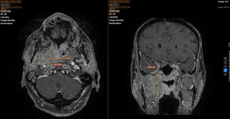 Hình ảnh cộng hưởng từ (MRI) cho thấy tổn thương thâm nhiễm vùng vòm họng và thành hầu miệng bên phải 