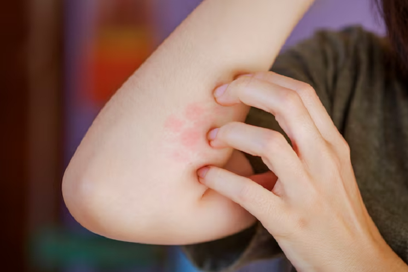 Ngứa da là dấu hiệu dễ gặp khi lây nhiễm sán chó