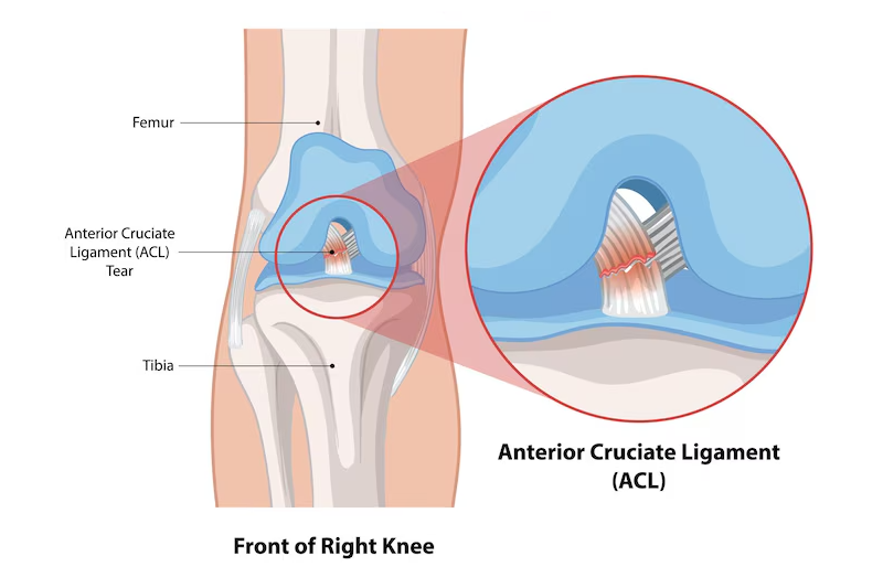 Chấn thương dây chằng khiến khớp gối bị đau nhức