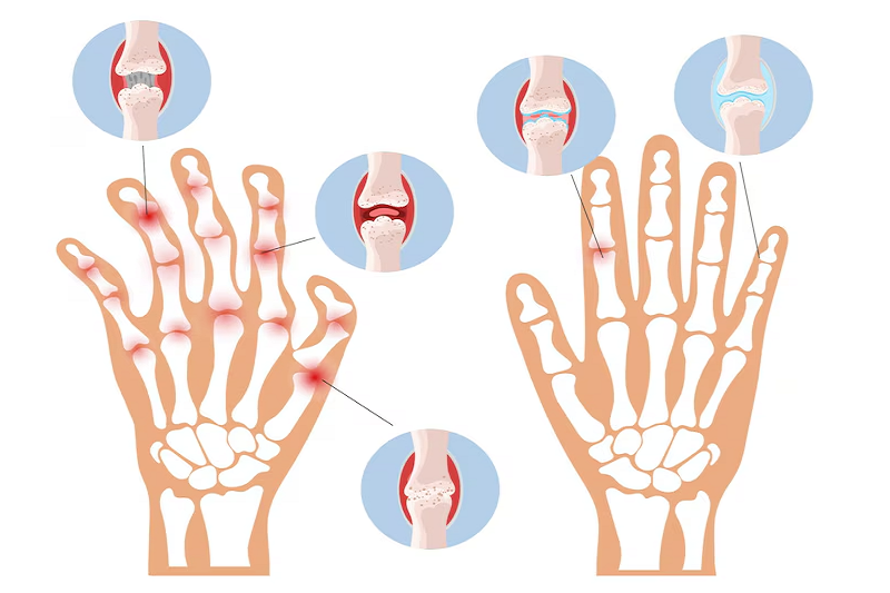 Hình ảnh mô phỏng tổn thương khớp trong bệnh viêm khớp dạng thấp