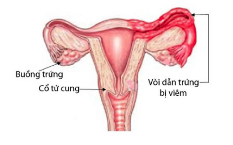 Viêm vòi trứng có thể xảy ra ở một hoặc hai bên vòi trứng