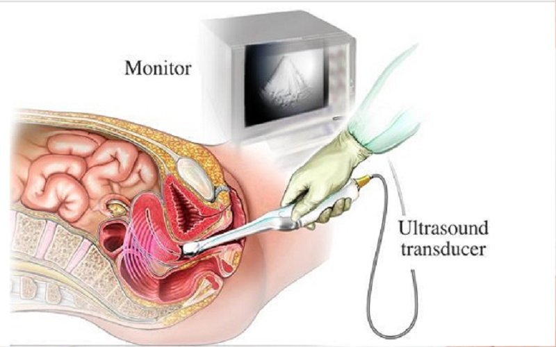 Siêu âm đầu dò âm đạo là phương tiện hình ảnh đầu tay hỗ trợ chẩn đoán viêm vòi trứng - viêm buồng trứng