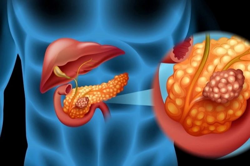 Ung thư tụy được xếp vào nhóm bệnh ung thư có tiên lượng xấu 