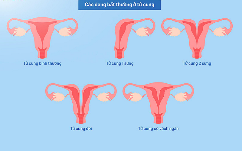 Dị dạng tử cung là một trong những nguyên nhân gây vô sinh nguyên phát ở nữ giới