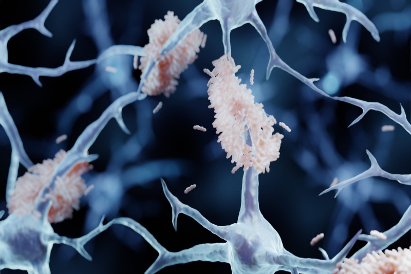 Sa sút trí tuệ trong bệnh Alzheimer là hậu quả của một quá trình thoái hóa thần kinh phức tạp, tiến triển mạn tính