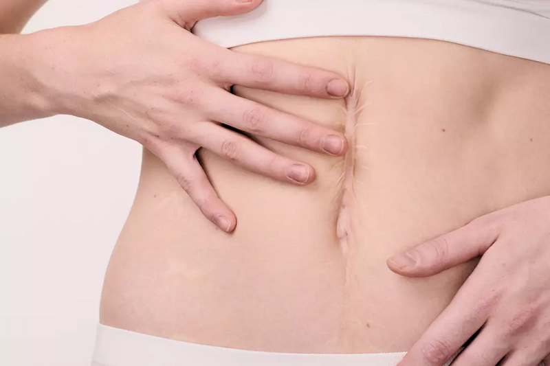 Tiền sử phẫu thuật ổ bụng là nguyên nhân hàng đầu gây ra thoát vị vết mổ.