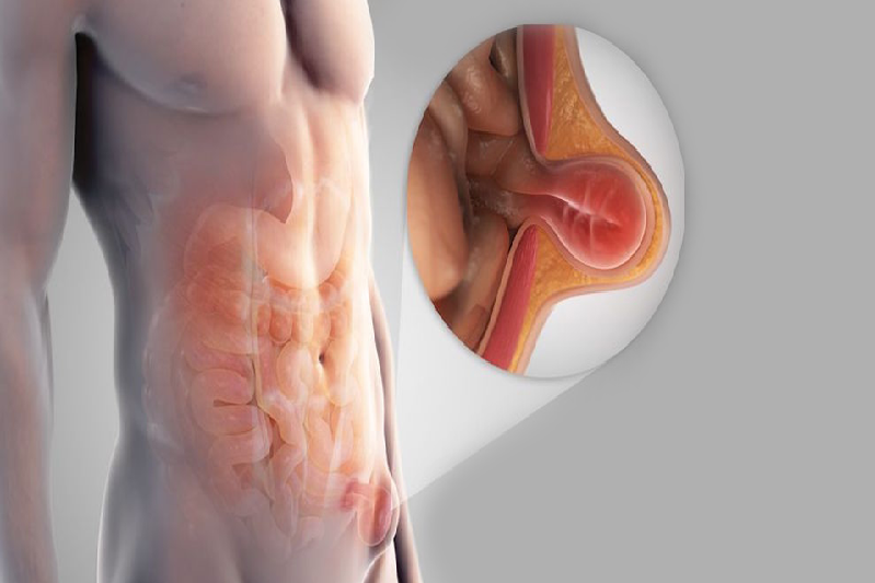 Thoát vị nghẹt có thể gây nôn ói, bí trung đại tiện - đây là những dấu hiệu cảnh báo cần can thiệp ngay lập tức. 