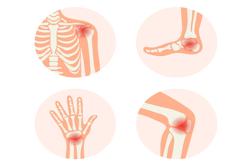 Tình trạng viêm đồng thời nhiều khớp trong bệnh viêm khớp không đặc hiệu