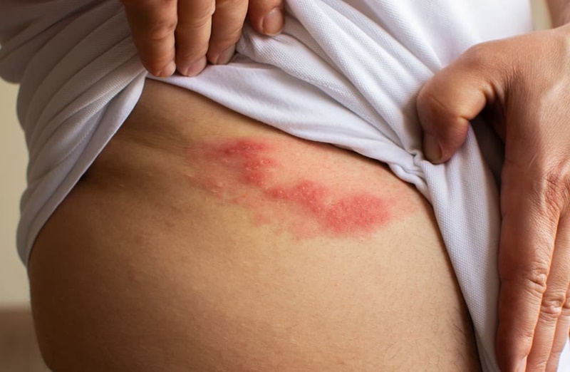Người bệnh có cảm giác đau rát như bị châm chích 