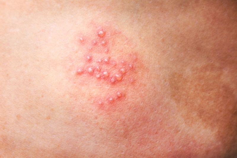 Những mụn nước trên vùng da bị bệnh zona