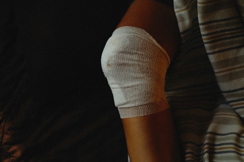 Chấn thương khớp gối là nguyên nhân thường gặp nhất gây liệt dây thần kinh hông khoeo ngoài.