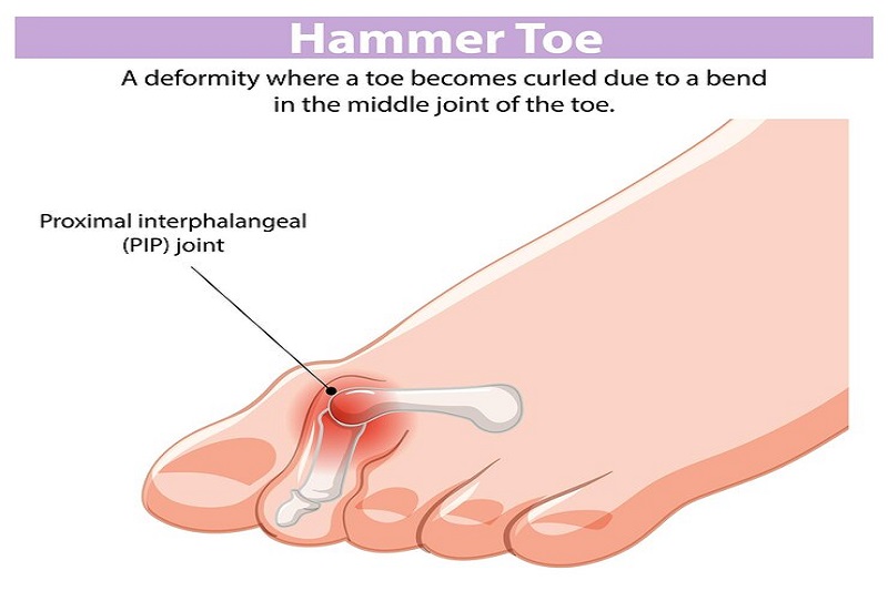 Ngón chân hình búa là dị tật bàn chân trước khá phổ biến hiện nay