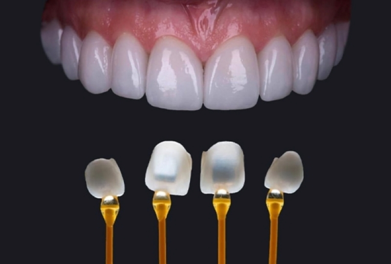 Dán răng sứ Veneer phù hợp với đối tượng răng ố vàng, xỉn màu 