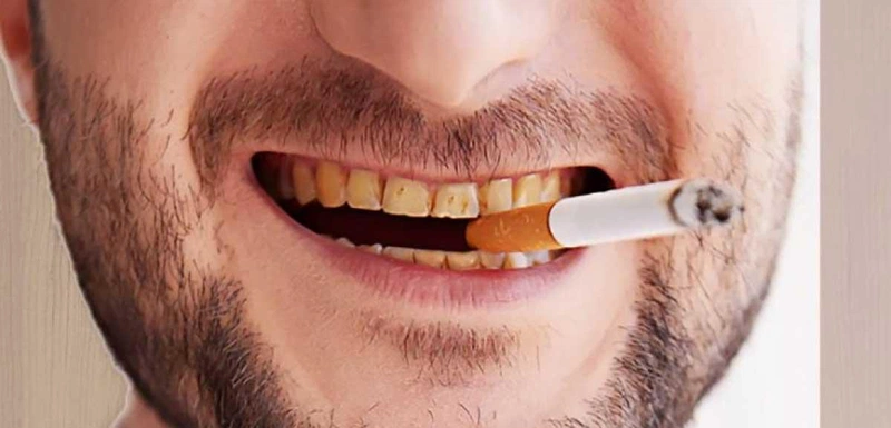 Không hút thuốc lá vì có thể khiến răng xỉn màu 