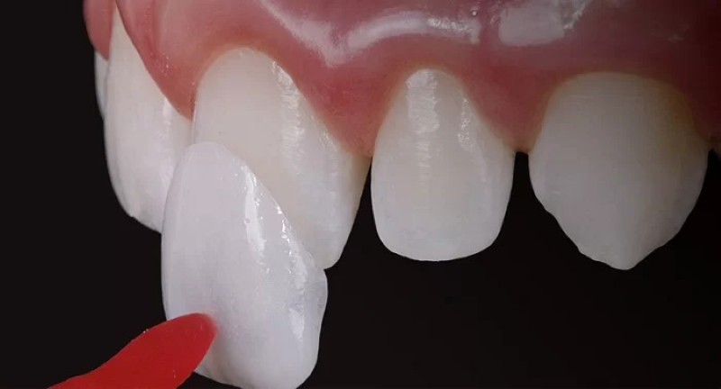 Dán răng sứ là biện pháp không gây cảm giác ê buốt, khó chịu 