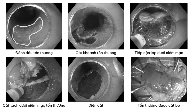 Tổn thương được loại bỏ bằng kỹ thuật xâm lấn tối thiểu - cắt tách dưới niêm mạc (ESD) 