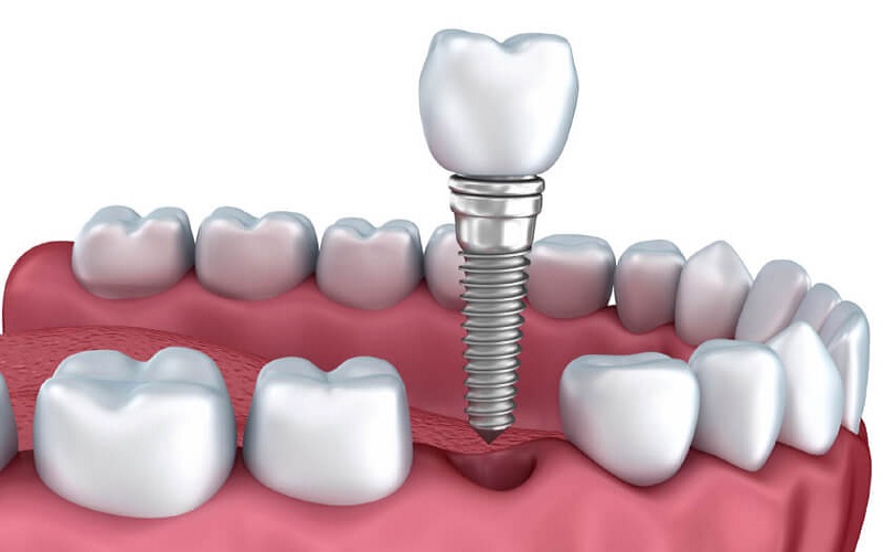 Trồng răng implant mang lại nhiều ưu điểm vượt trội 