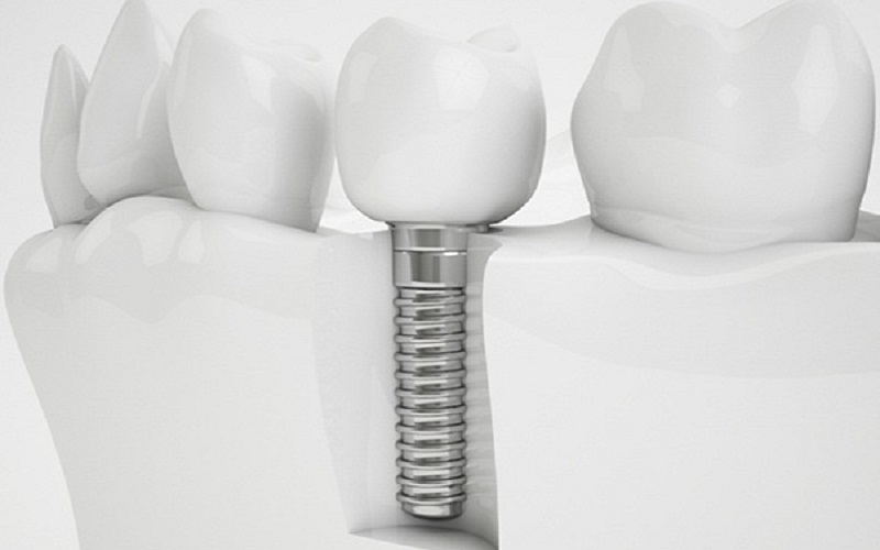 Trồng răng số 7 hàm dưới giá bao nhiêu tiền - câu trả lời cần được cân nhắc dựa trên nhiều yếu tố 