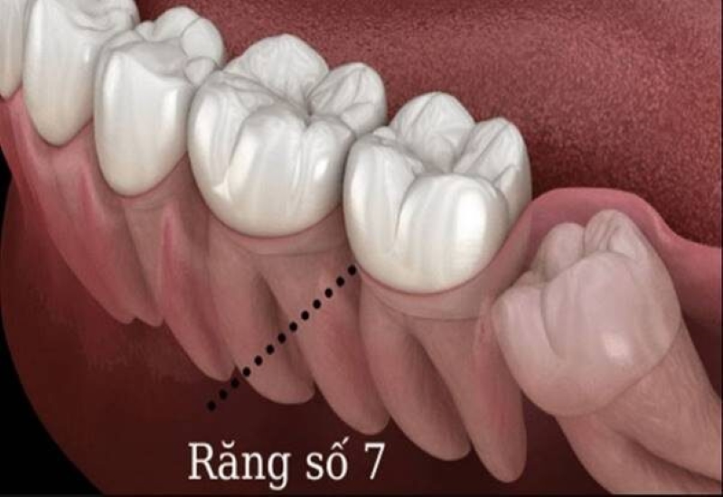 Mất răng số 7 sẽ khiến chức năng ăn nhai bị ảnh hưởng nghiêm trọng 