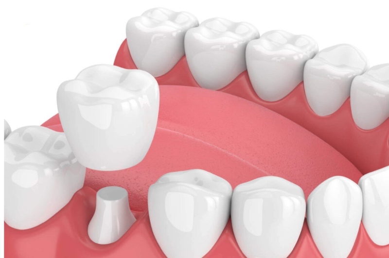 Bọc răng sứ là kỹ thuật phổ biến trong lĩnh vực Răng hàm mặt 