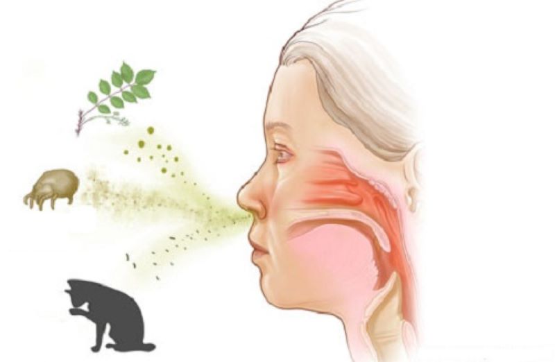 Viêm mũi xoang dị ứng là bệnh lý phổ biến 