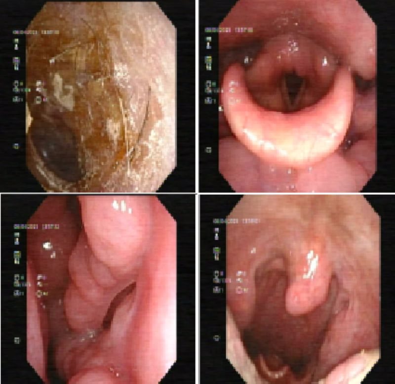 Hình ảnh nội soi tai mũi họng của bệnh nhân 