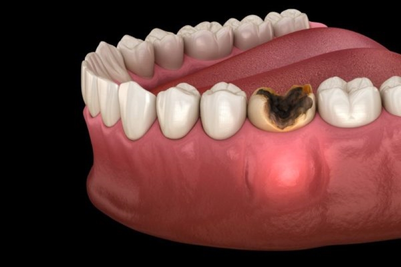 Trường hợp sâu răng mức độ nặng có thể cần nhổ răng vĩnh viễn 