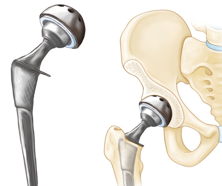  Thay khớp háng nhân tạo là biện pháp điều trị hiệu quả trong trường hợp nặng