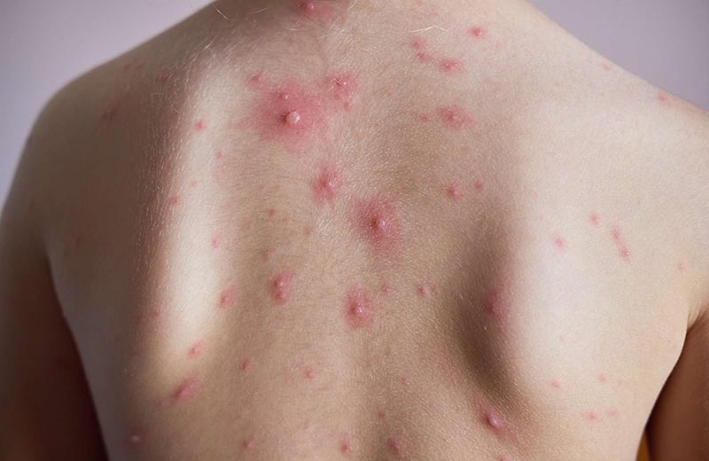 Thủy đậu gây ra những tổn thương trên da