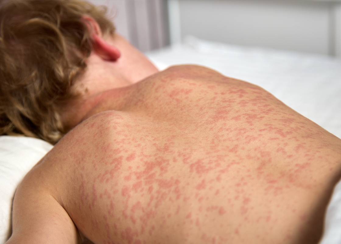 Bé trai mắc sởi sau nhiều ngày sốt cao liên tục. (Ảnh minh họa: johnscreekdermatology)