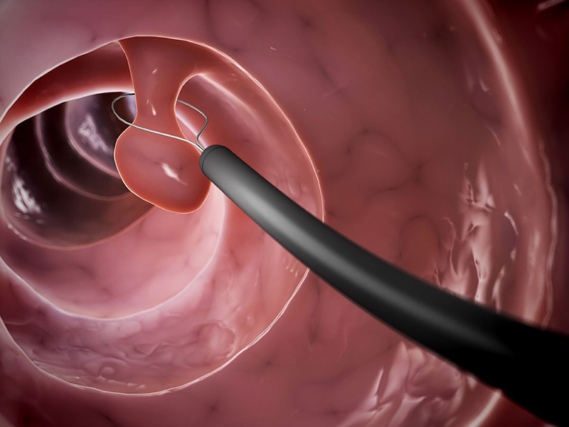 Tầm soát ung thư giúp loại bỏ polyp trước khi chúng tiến triển thành tế bào ung thư