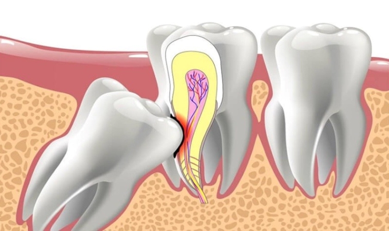 Răng khôn có mấy chân - câu trả lời là dao động từ 1 đến 4 chân 