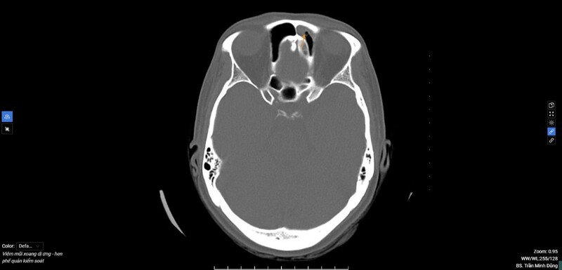 Hình ảnh CT cho thấy chị H., bị viêm đa xoang và xoang hàm phải nghi nhiễm nấm 