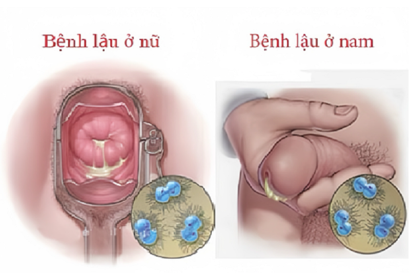 Biểu hiện tại cơ quan sinh dục khi nhiễm lậu cầu chủ yếu là tiết dịch mủ