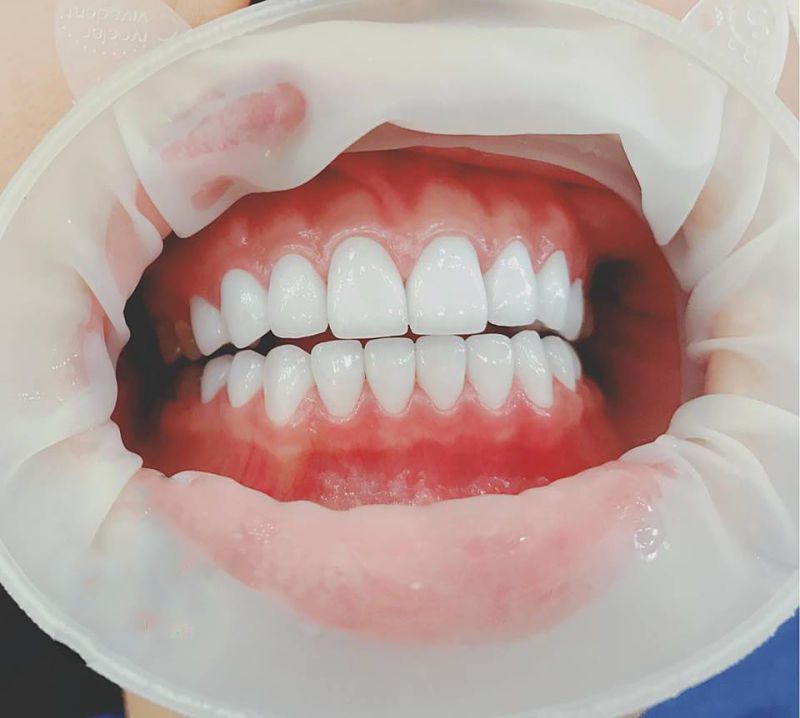 Bọc răng sứ có đau không là vấn đề nhiều người lo ngại 