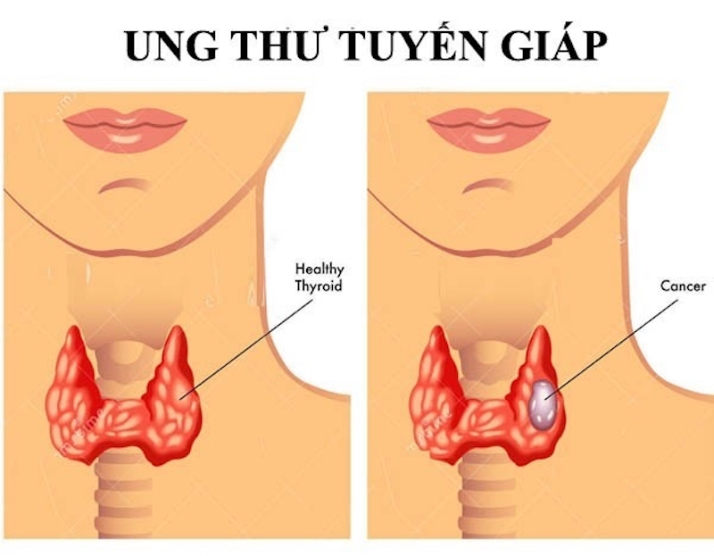 Tỷ lệ mắc ung thư tuyến giáp ở nữ cao gấp 4 lần nam giới (Thống kê từ Tổ chức Y tế Thế giới năm 2022) 