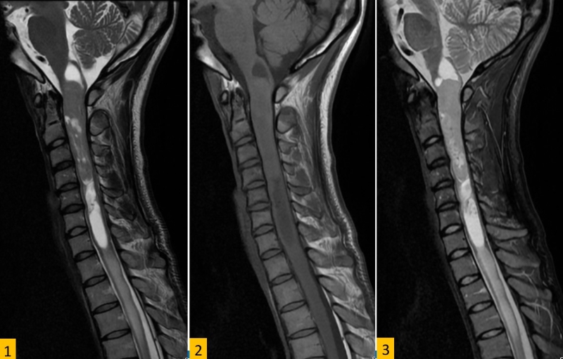 Khối u được phát hiện trên hình ảnh chụp MRI vùng cổ 