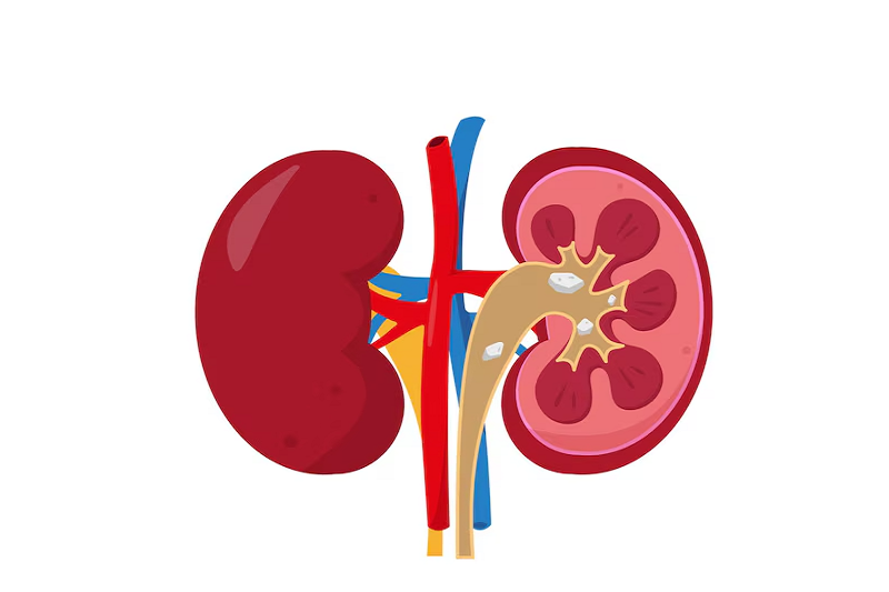 Tắc nghẽn niệu quản do sỏi có thể gây nên giãn niệu quản