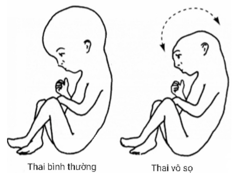 Thai vô sọ là dị tật nghiêm trọng và phổ biến nhất trong các dị tật ống thần kinh.