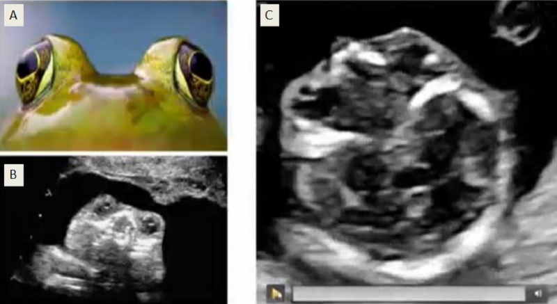 Hình B mắt lồi ra như mắt ếch (Frog eye sign), nguyên nhân do mất xương trán trong thai vô sọ. Hình C là hình ảnh mắt bình thường. 