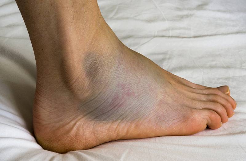 Phù nề là dấu hiệu điển hình của rối loạn chuyển hoá protid