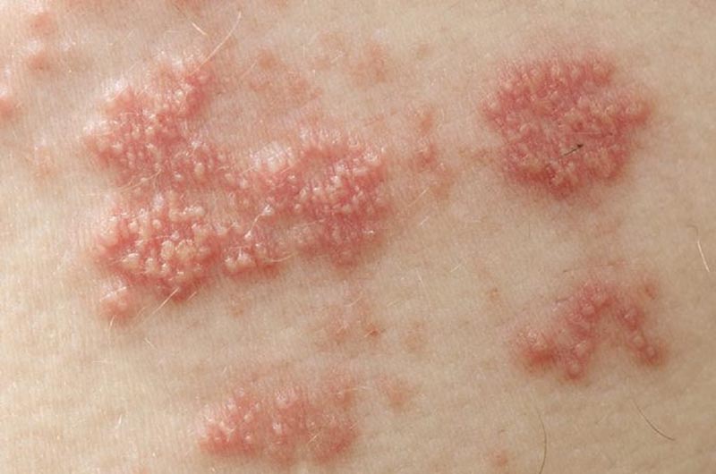 Mụn nước thành chùm kèm cảm giác ngứa, châm chích là triệu chứng điển hình của bệnh zona