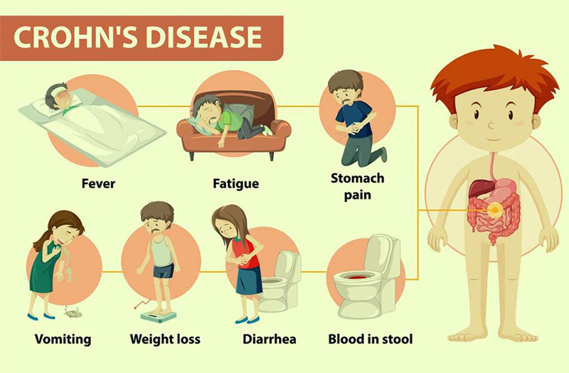 Triệu chứng chính của bệnh Crohn là gì?
