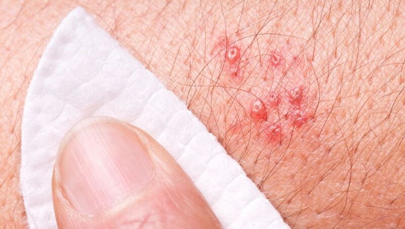 Nổi mụn nước kèm ngứa rát là dấu hiệu điển hình của bệnh zona thần kinh