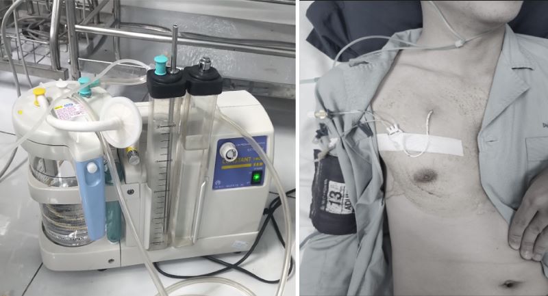 Bệnh nhân được đặt catheter dẫn lưu khoang màng phổi tại Bệnh viện Đa khoa MEDLATEC 
