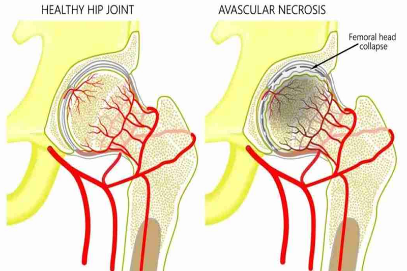 Hoại tử xương là tình trạng tế bào xương bị chết do mất nguồn máu nuôi dưỡng.